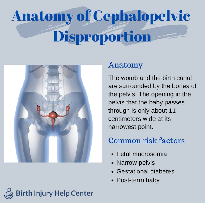 Anatomy of Cephalopelvic Disproportion