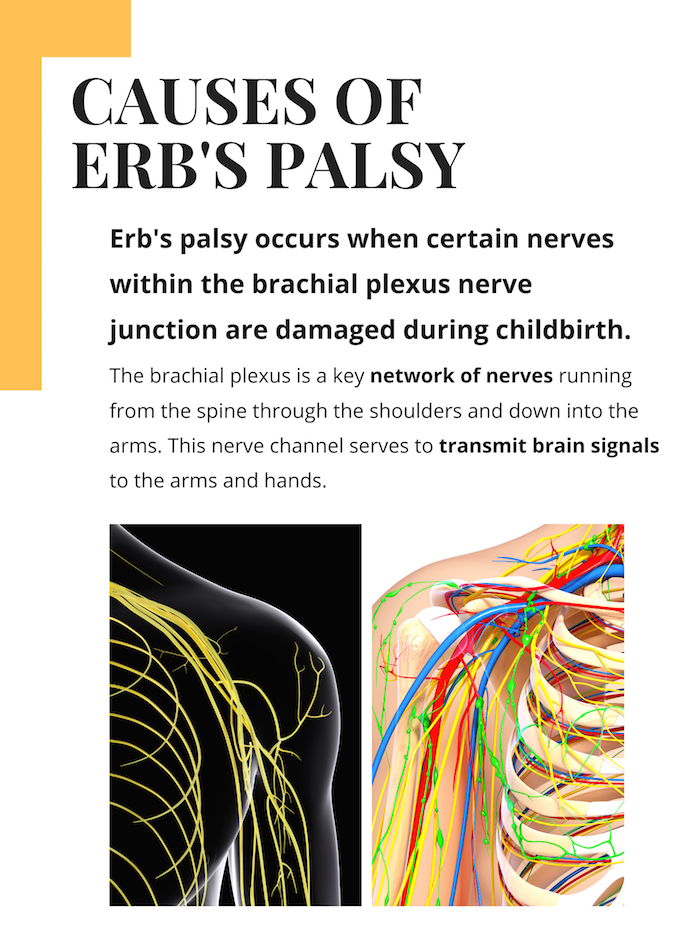 Causes of Erb's Palsy Infographic