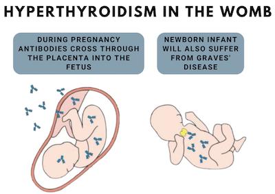 hyperthyroidism pregnancy