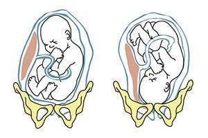 Breech Position