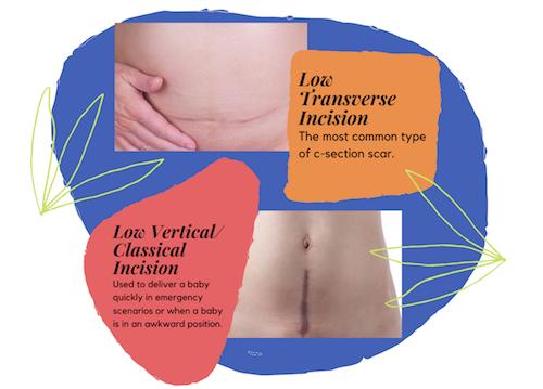 Low Transverse Incision